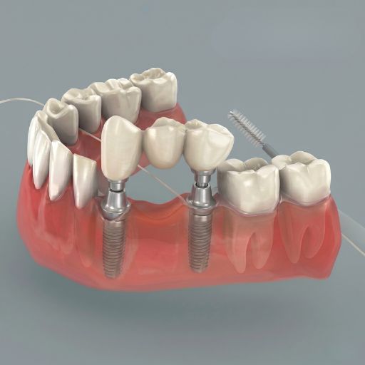 Fixed-Set Teeth (Prosthodontics)